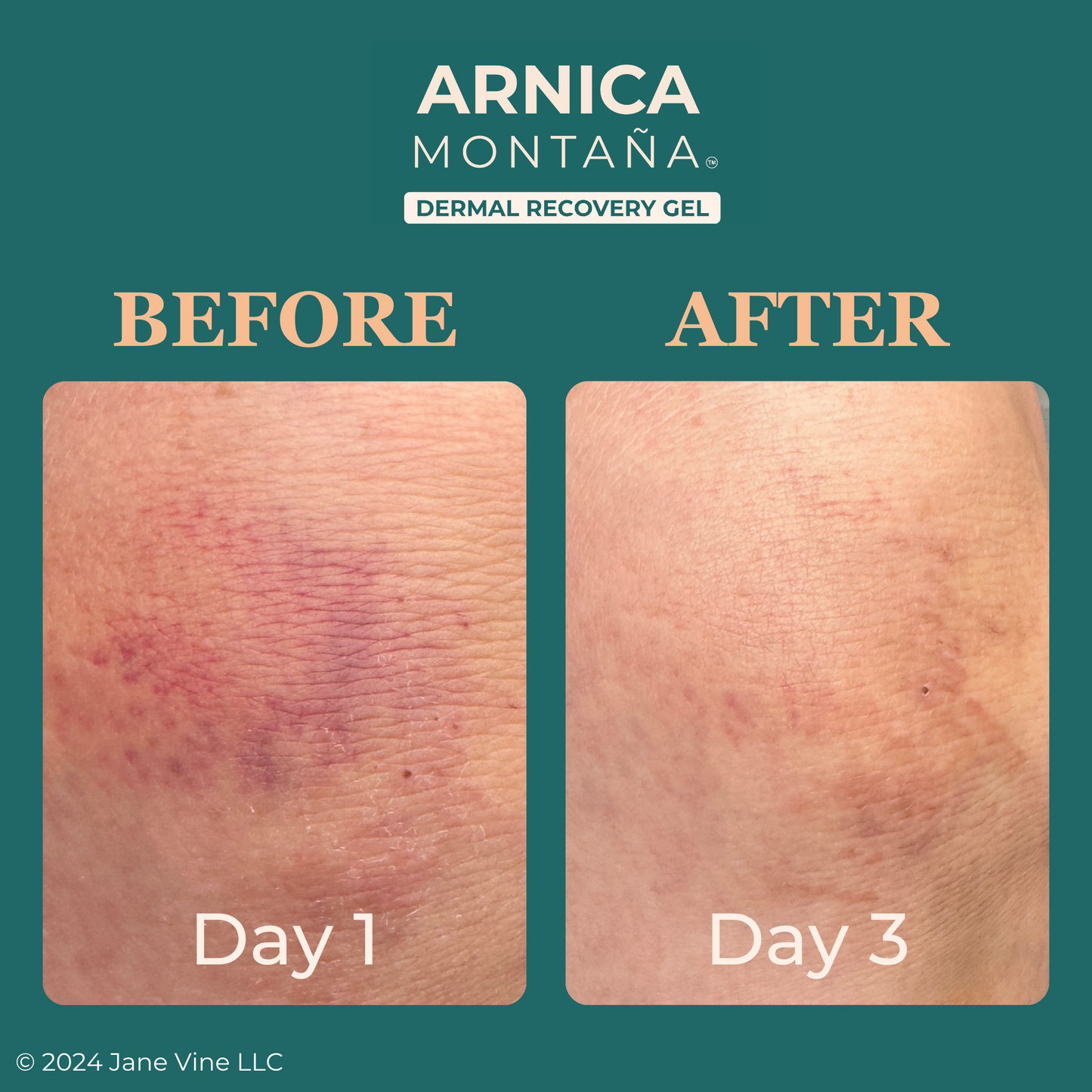 Jane Vine Arnica Gel – Arnica Montana for Face, Bruises, Muscle Soreness & Post-Workout Recovery – 7 oz