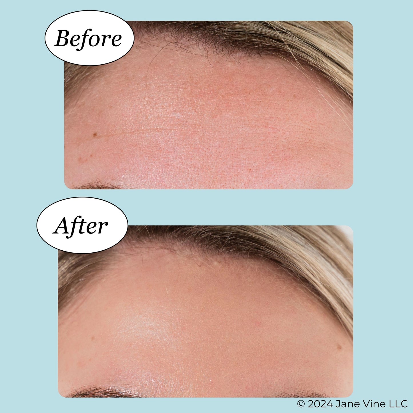 Forehead Wrinkle Patches - Anti Wrinkle Patches - Cooling Collagen Hydration - Wrinkles Treatment - Forehead Collagen Patches with Centella Asiatica, Vitamin E & Hyaluronic Acid - 20 Pcs
